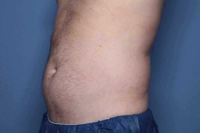 Liposuction Before & After Gallery - Patient 363436 - Image 3