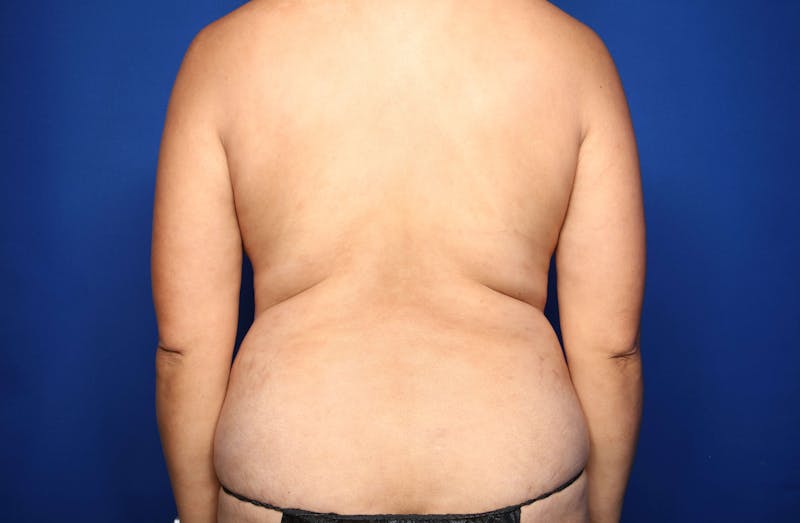 Tummy Tuck Before & After Gallery - Patient 344935 - Image 5
