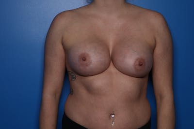 Breast Augmentation Before & After Gallery - Patient 671474 - Image 2