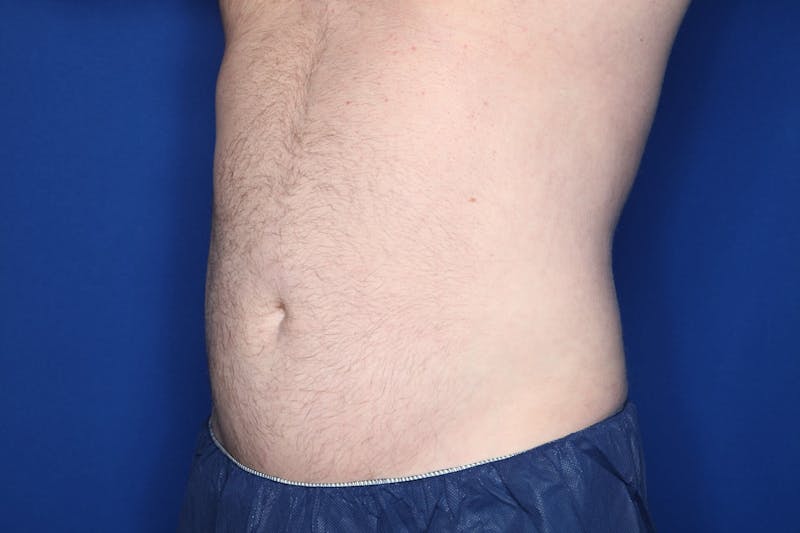 Liposuction Before & After Gallery - Patient 363436 - Image 4