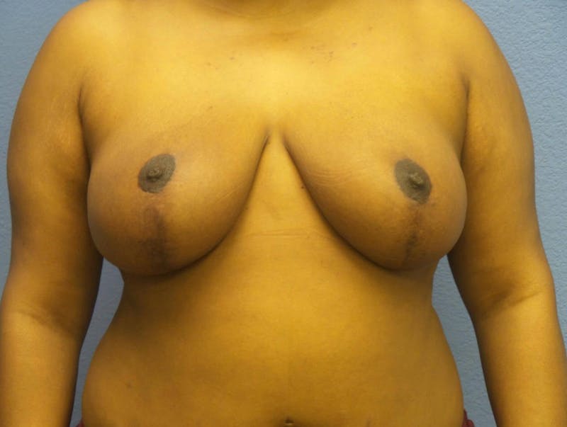 Breast Reduction Before & After Gallery - Patient 162728 - Image 4