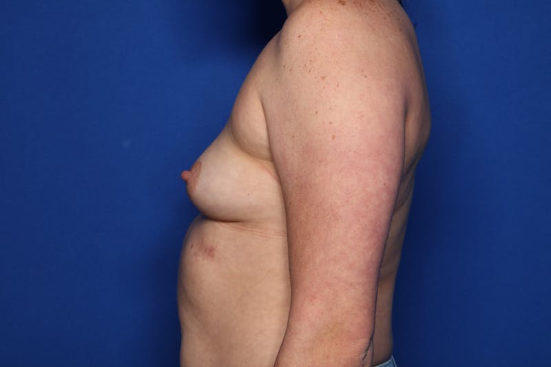 Breast Augmentation Before & After Gallery - Patient 671474 - Image 3