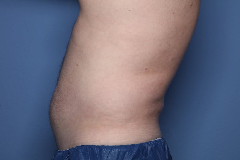 Liposuction Before & After Gallery - Patient 363436 - Image 5