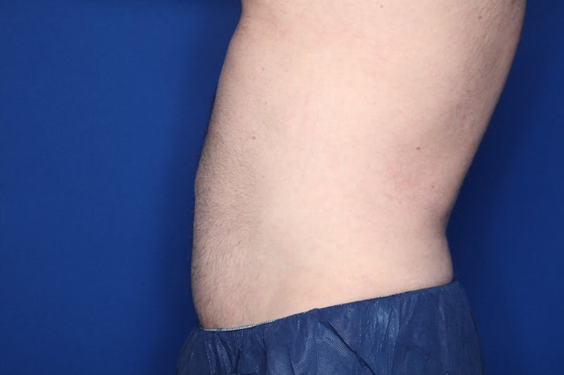 Liposuction Before & After Gallery - Patient 363436 - Image 6