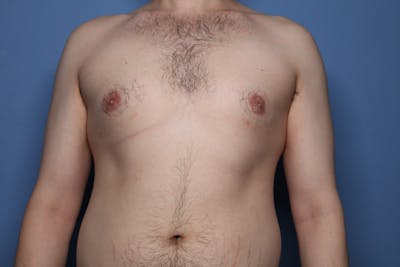 Gynecomastia (Male Breast Reduction) Before & After Gallery - Patient 317358 - Image 1
