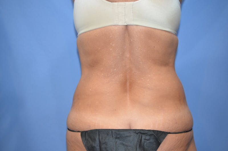 BodyTite™ Before & After Gallery - Patient 110220 - Image 5