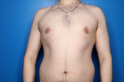 Gynecomastia (Male Breast Reduction) Before & After Gallery - Patient 317358 - Image 2
