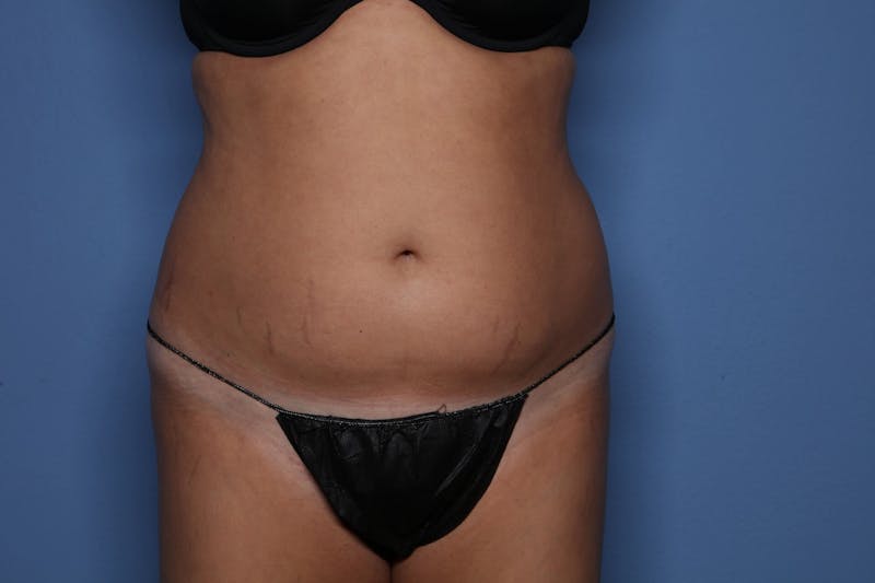 Liposuction Before & After Gallery - Patient 200699 - Image 1