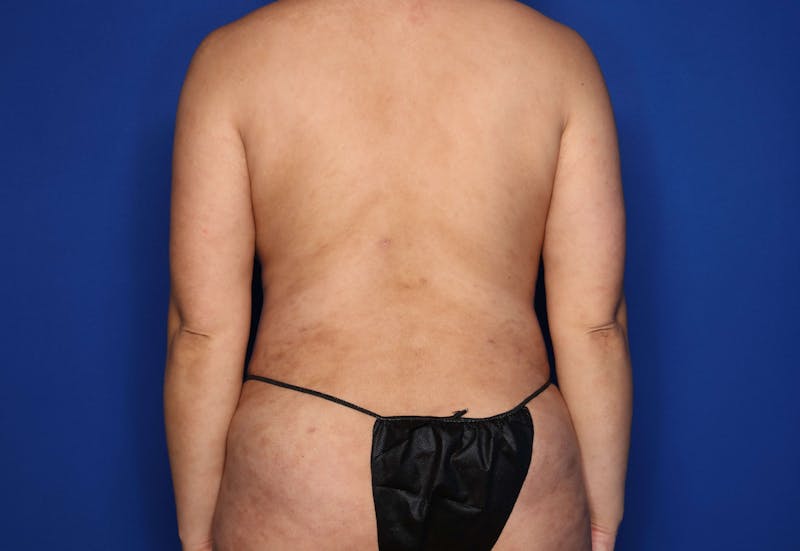 Tummy Tuck Before & After Gallery - Patient 344935 - Image 6