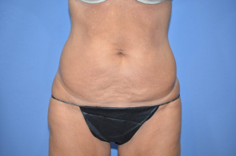 BodyTite™ Before & After Gallery - Patient 110220 - Image 7