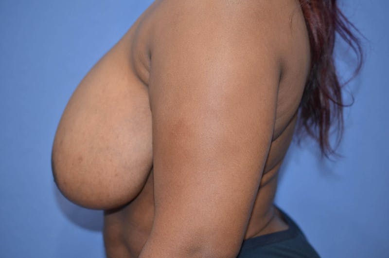 Breast Reduction Before & After Gallery - Patient 120102 - Image 3