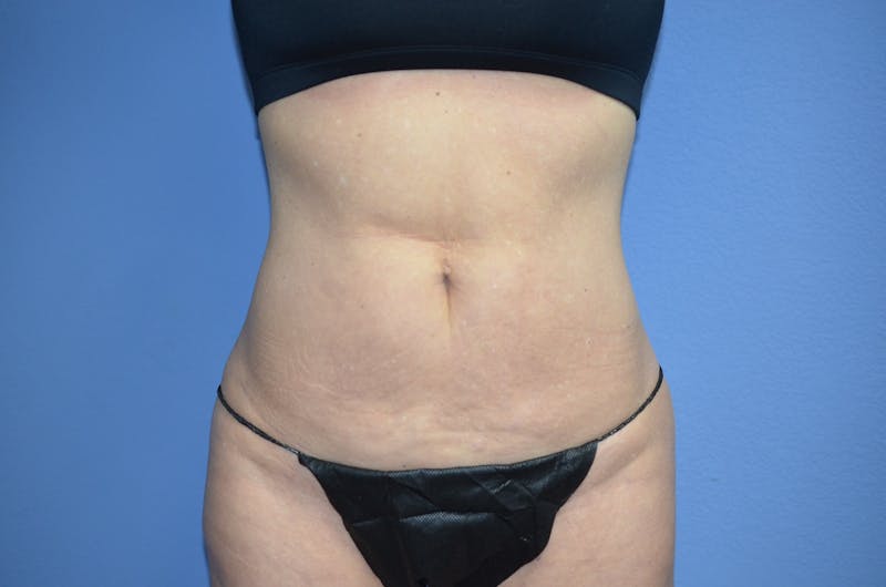 BodyTite™ Before & After Gallery - Patient 110220 - Image 8