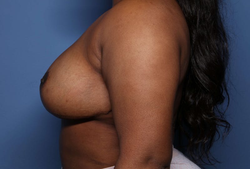 Breast Reduction Before & After Gallery - Patient 120102 - Image 4