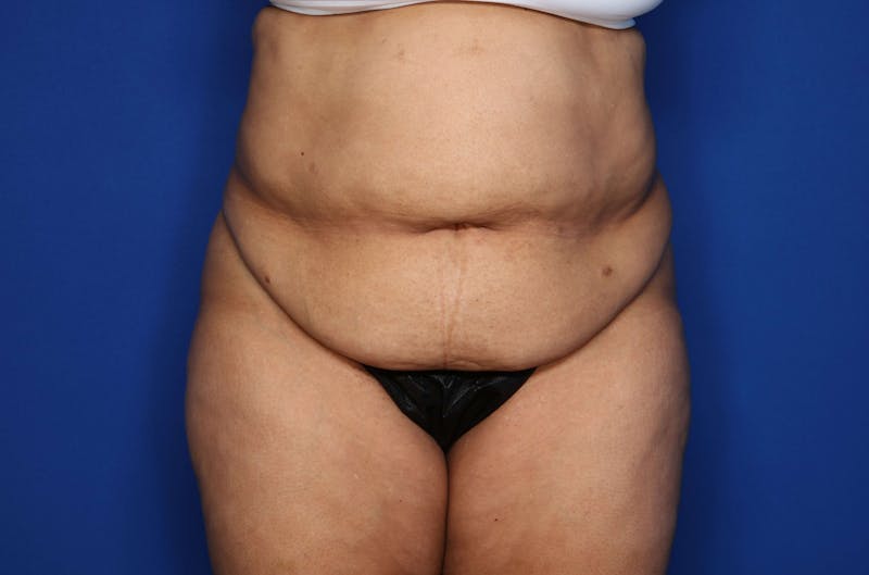 Tummy Tuck Before & After Gallery - Patient 243652 - Image 1