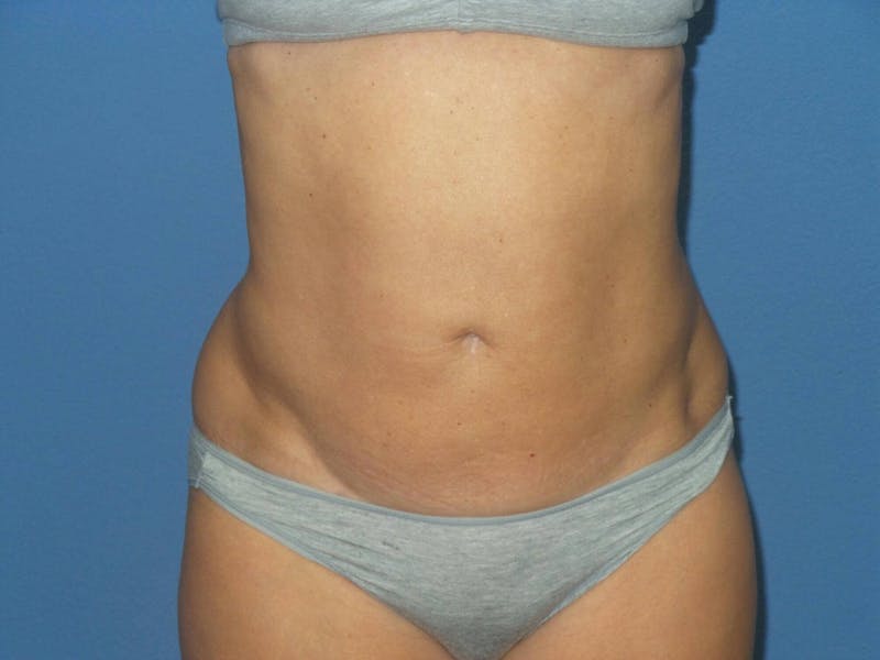 BodyTite™ Before & After Gallery - Patient 103921 - Image 2