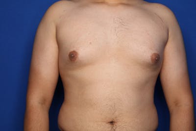 Gynecomastia (Male Breast Reduction) Before & After Gallery - Patient 106330 - Image 1