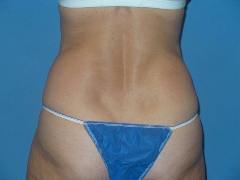 BodyTite™ Before & After Gallery - Patient 103921 - Image 3