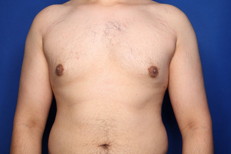Gynecomastia (Male Breast Reduction) Before & After Gallery - Patient 106330 - Image 2