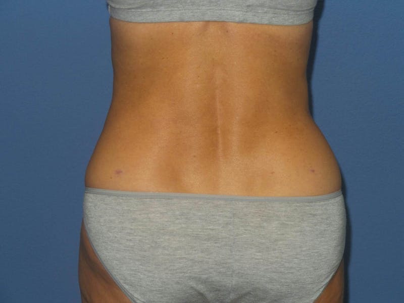 BodyTite™ Before & After Gallery - Patient 103921 - Image 4
