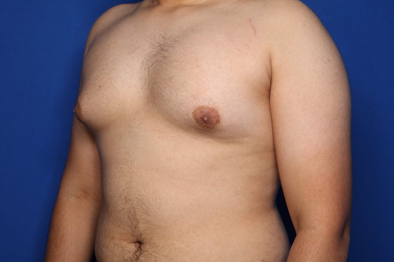 Gynecomastia (Male Breast Reduction) Before & After Gallery - Patient 106330 - Image 3