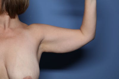 Liposuction Before & After Gallery - Patient 147177 - Image 1