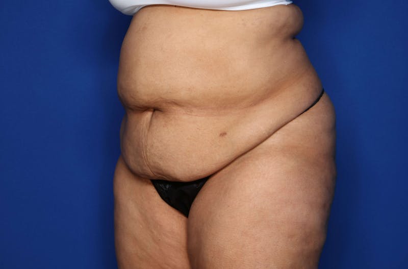 Tummy Tuck Before & After Gallery - Patient 243652 - Image 3