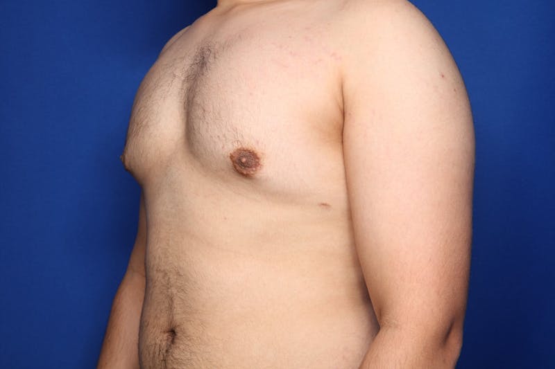 Gynecomastia (Male Breast Reduction) Before & After Gallery - Patient 106330 - Image 4
