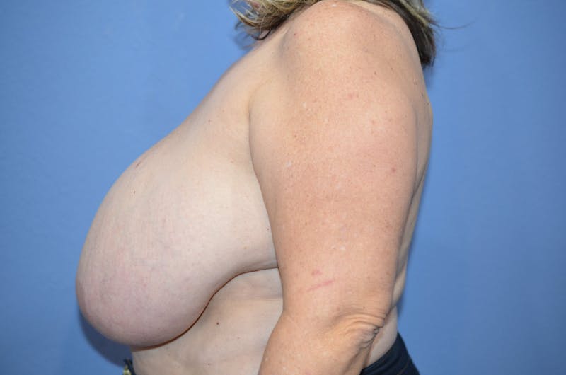 Breast Reduction Before & After Gallery - Patient 196677 - Image 3