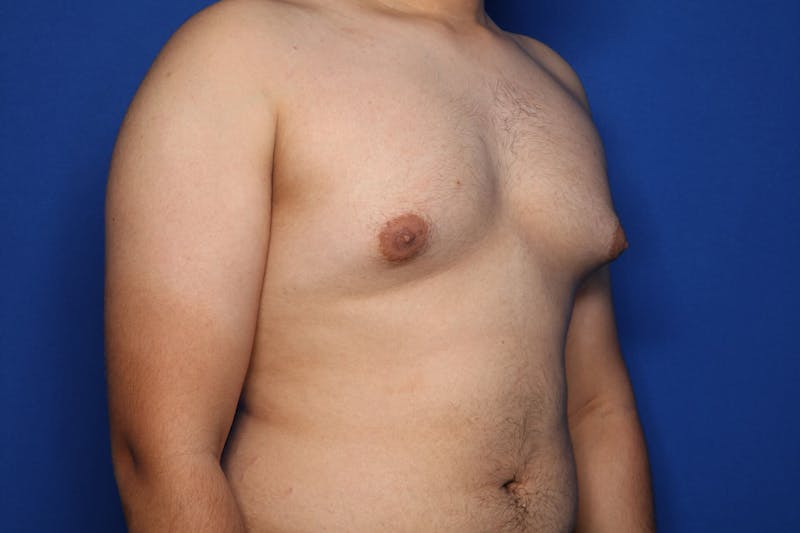 Gynecomastia (Male Breast Reduction) Before & After Gallery - Patient 106330 - Image 5
