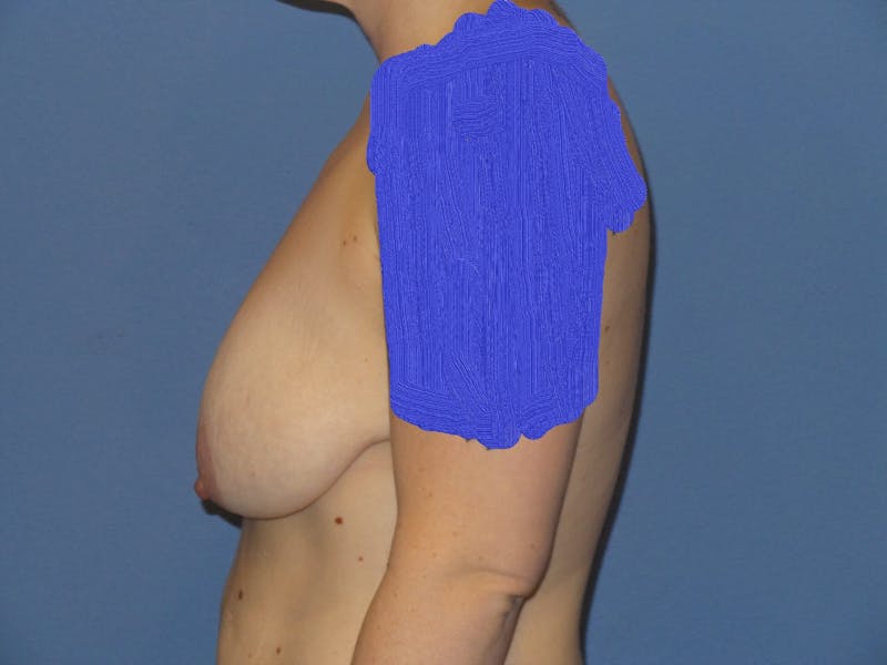 Breast Augmentation + Lift Before & After Gallery - Patient 273579 - Image 3