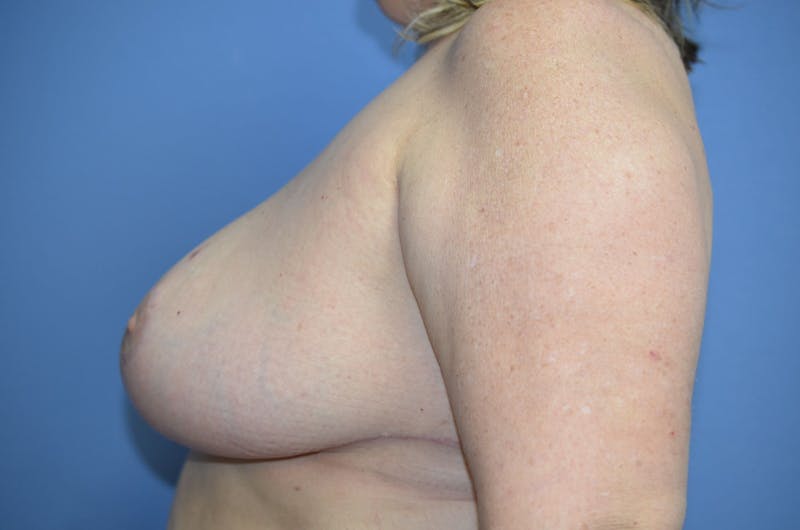 Breast Reduction Before & After Gallery - Patient 196677 - Image 4