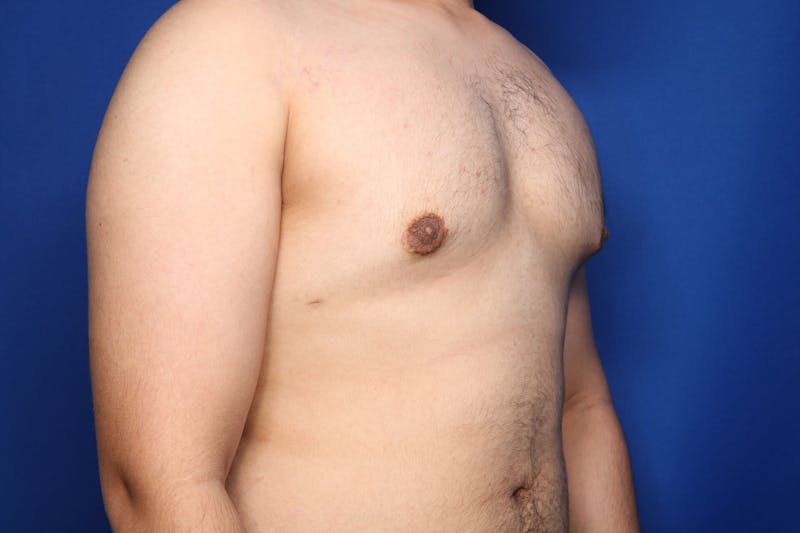 Gynecomastia (Male Breast Reduction) Before & After Gallery - Patient 106330 - Image 6