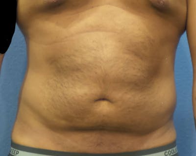 Liposuction Before & After Gallery - Patient 477043 - Image 1