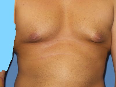 Gynecomastia (Male Breast Reduction) Before & After Gallery - Patient 307008 - Image 1