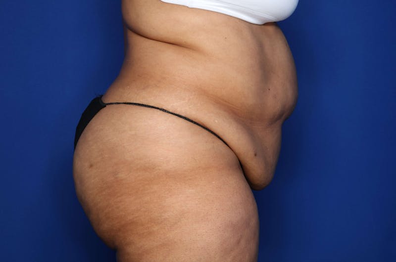 Tummy Tuck Before & After Gallery - Patient 243652 - Image 5