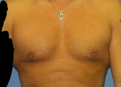 Gynecomastia (Male Breast Reduction) Before & After Gallery - Patient 307008 - Image 2