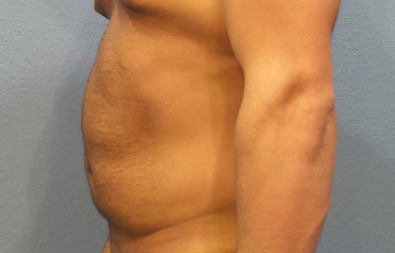 Liposuction Before & After Gallery - Patient 477043 - Image 3
