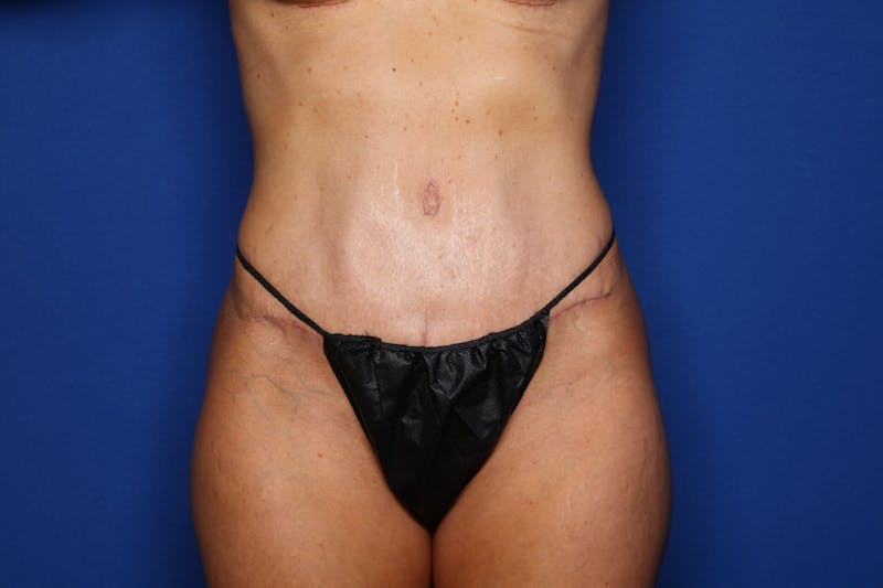 Breast Augmentation Before & After Gallery - Patient 300168 - Image 6