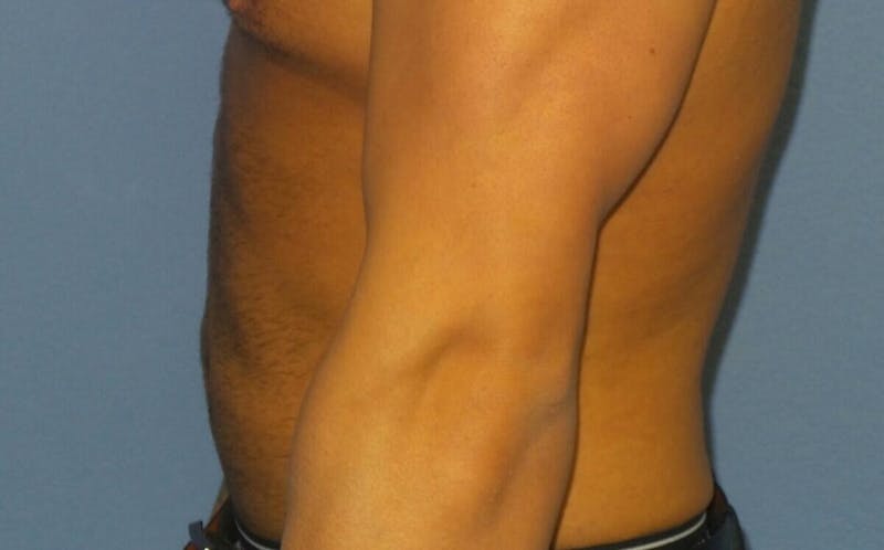 Liposuction Before & After Gallery - Patient 477043 - Image 4