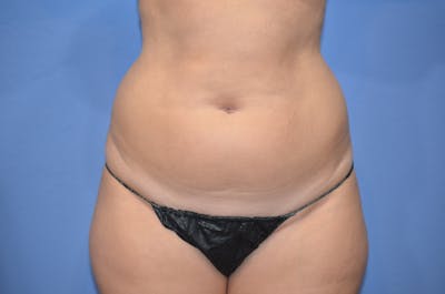 Liposuction Before & After Gallery - Patient 343475 - Image 1