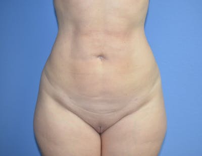 Liposuction Before & After Gallery - Patient 343475 - Image 2