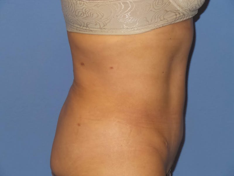 BodyTite™ Before & After Gallery - Patient 115258 - Image 6