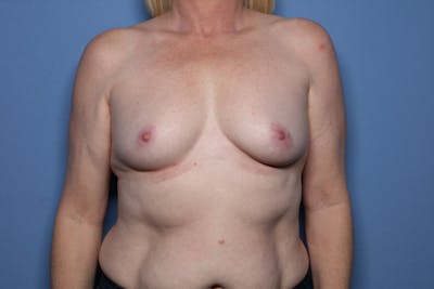 Breast Augmentation Before & After Gallery - Patient 323770 - Image 1