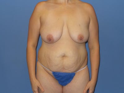 Mommy Makeover Before & After Gallery - Patient 212693 - Image 1