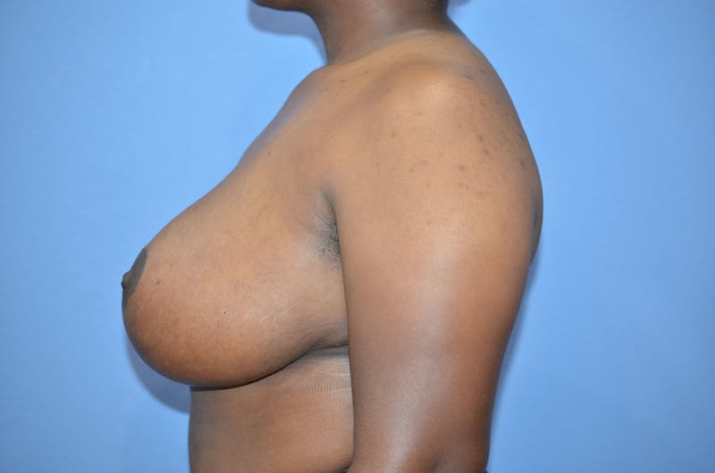Breast Reduction Before & After Gallery - Patient 130874 - Image 4