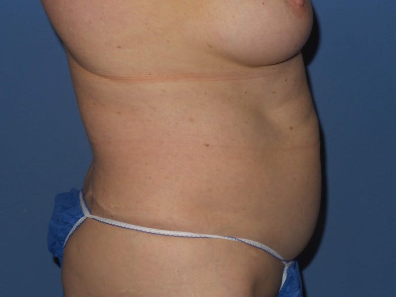 BodyTite™ Before & After Gallery - Patient 237245 - Image 3