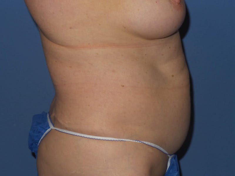 BodyTite™ Before and After Before & After Gallery - Patient 237245 - Image 3