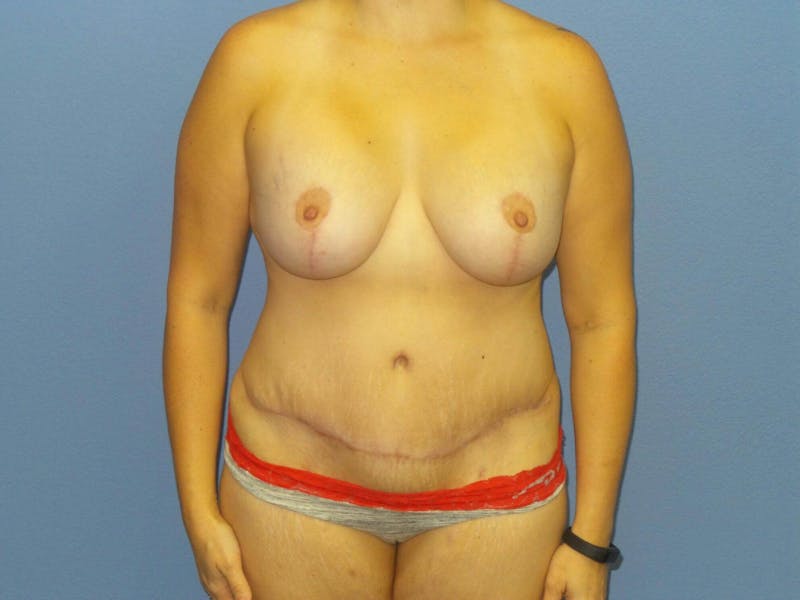 Mommy Makeover Before & After Gallery - Patient 212693 - Image 2