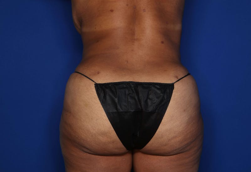 Tummy Tuck Before & After Gallery - Patient 243652 - Image 8