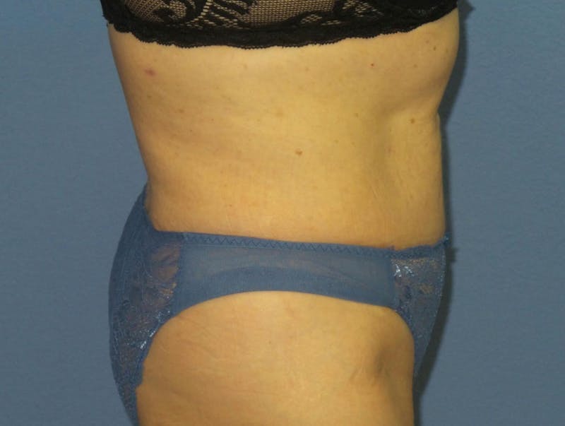 BodyTite™ Before & After Gallery - Patient 237245 - Image 4